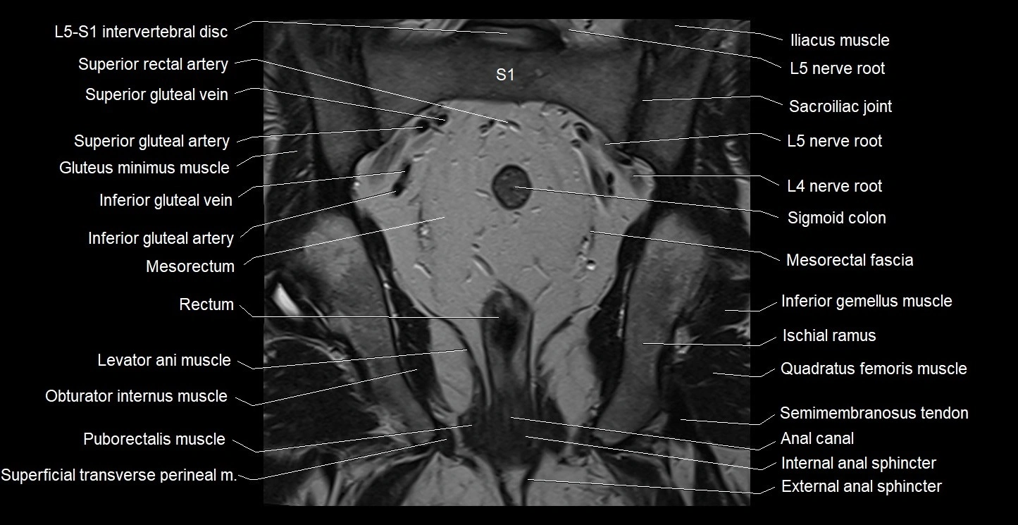 MRI coronal cross sectional anatomy male pelvis image 26.webp